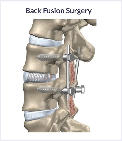 Back-Fusion-Surgery