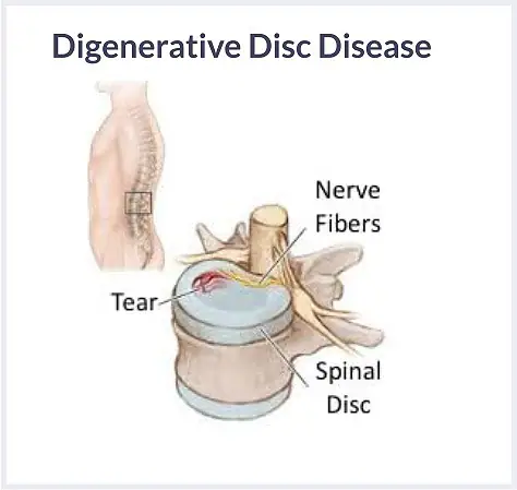 Disc-Degeneration