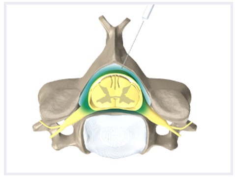 Epidural-Steroid -Injections