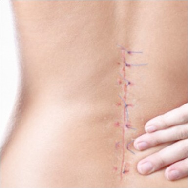 Failed-Back-Surgery-image