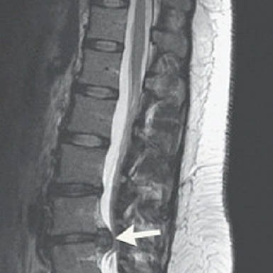 Intradisc-Fibrin-image