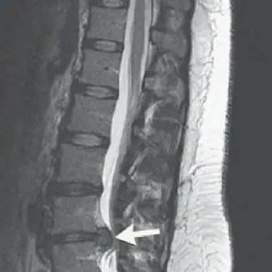 Intradisc-Fibrin-image