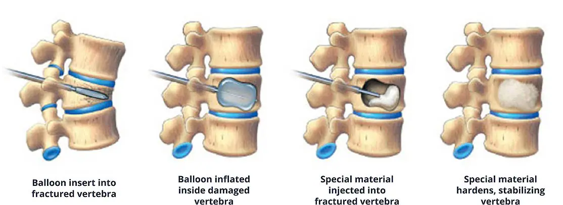 Kyphoplasty-four-image
