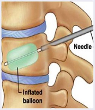 Kyphoplasty-image