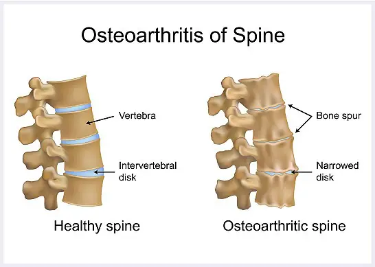 Osteoarthritis-of-spine