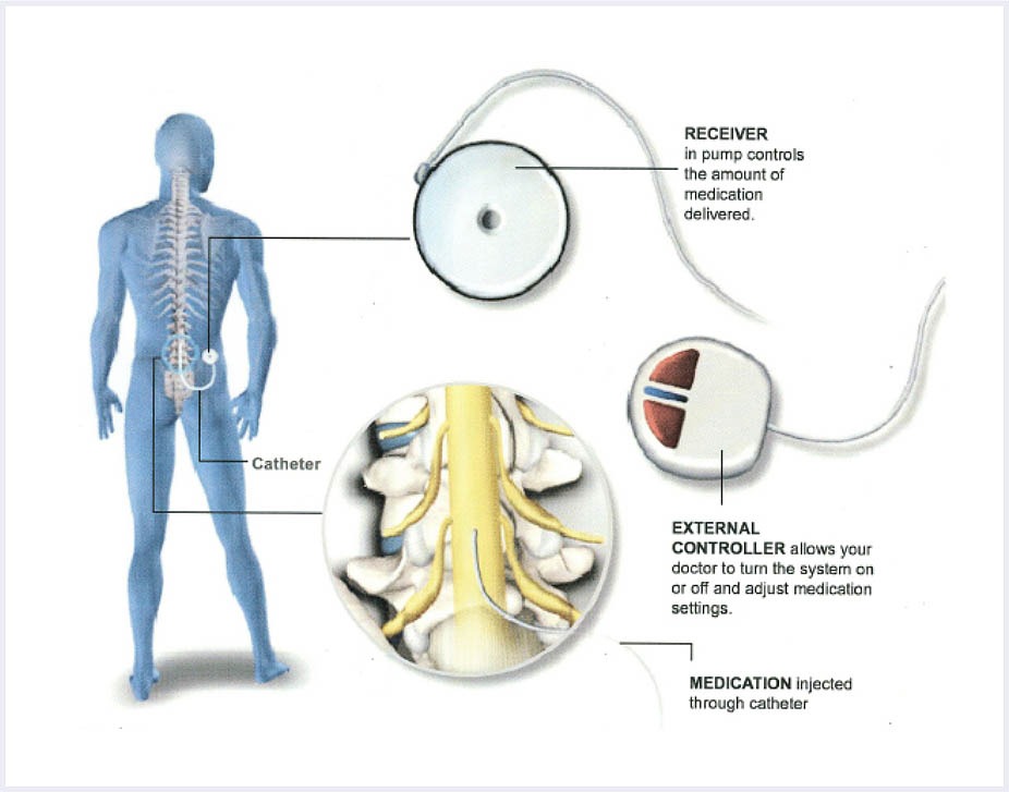 Spinal Column and Peripheral Nerve Stimulator - Back Pain Treatment