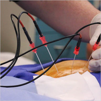RF-Ablation-image