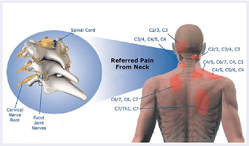 Referred-pain-image