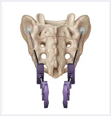 Sacroplasty-image-Procedure