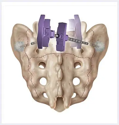 Sacroplasty-image