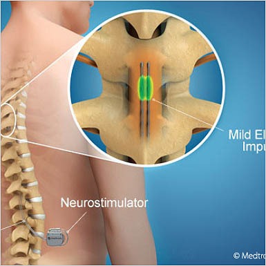 Spinal-cord-stimulation-image