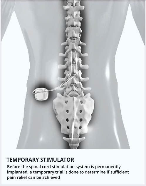 https://www.backpaintreatment.com/wp-content/uploads/2020/06/Temporary-stimulator-image.jpg