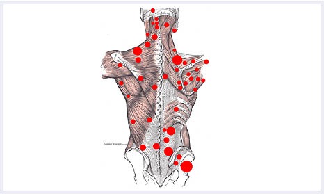 Trigger-Point-Injections