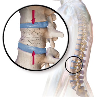 Vertebral-Compression-Fractures-image