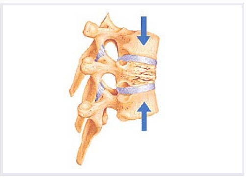 compression-fracturs-image