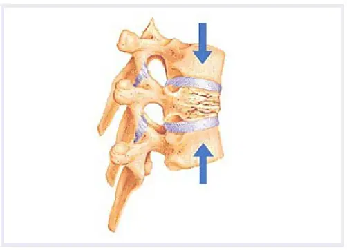 compression-fracturs-image