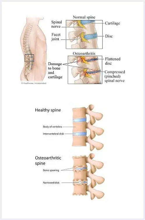 degenerative-joint-disease