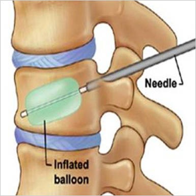 kyphoplasty-image