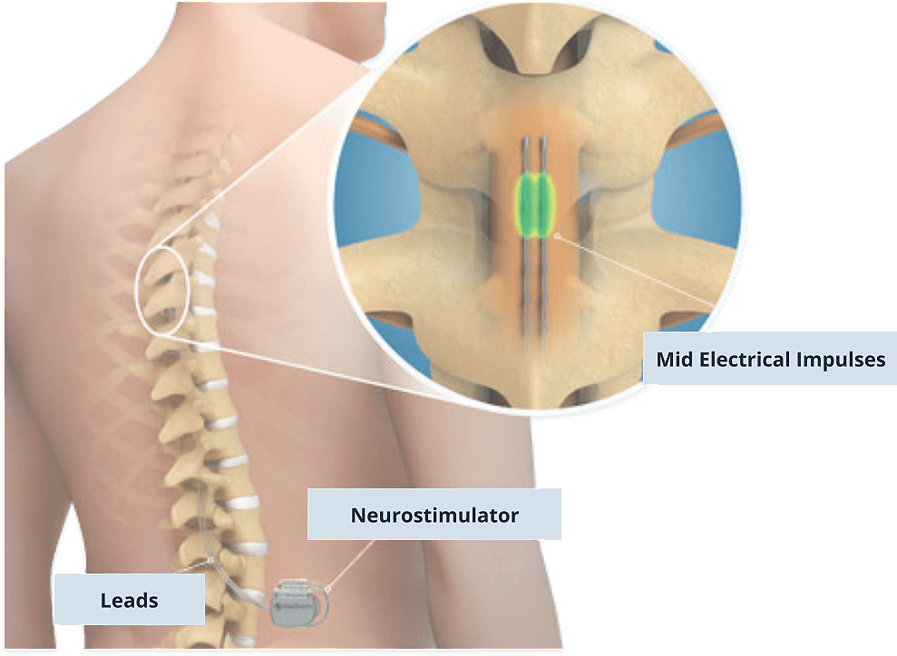 a peripheral nerve or dorsal column stimulator