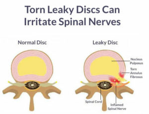 Intervertebral Disc Disease Treatment - Discseel - Back Pain Treatment
