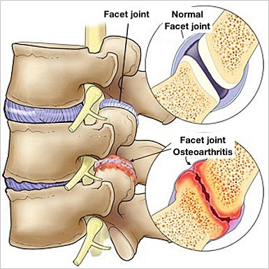 Facet Joint Arthritis