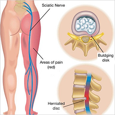 Sciatica