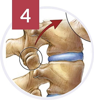 facet joint injections