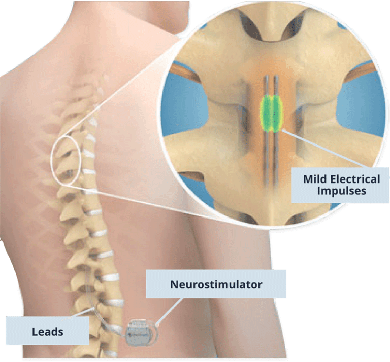 dorsal column stimulator insurance approval why psychiatrist