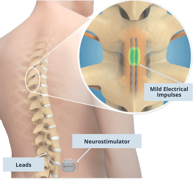 Spinal Column and Peripheral Nerve Stimulator - Back Pain Treatment