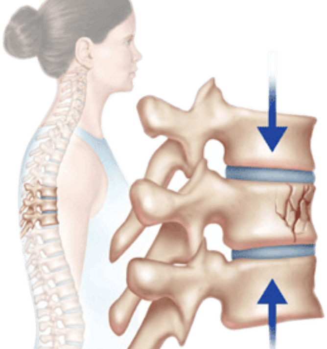 Compression Fractures Treatment- Back Pain Treatment