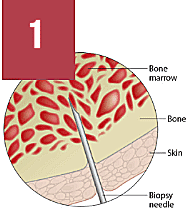 stem cell therapy