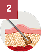 fat regenerative medicine