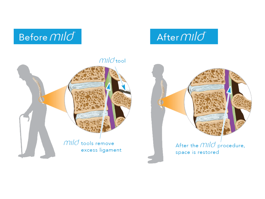 MILD procedure for spinal stenosis