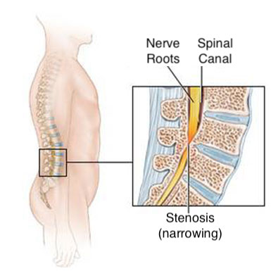 Spinal Stenosis