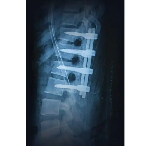 discseel-spine-xray Discseel procedure